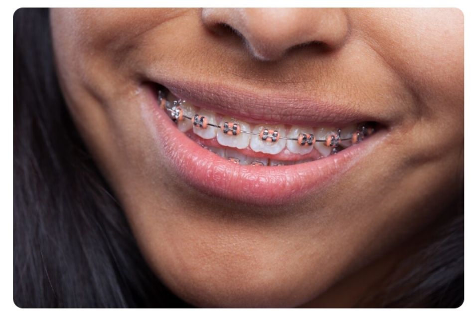 metal braces cost in pune 